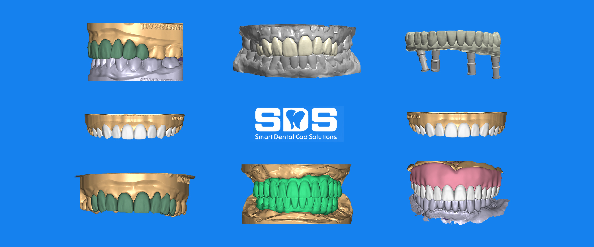 dental-implant